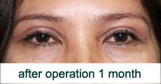 plastic-surgery-blepharoplasty